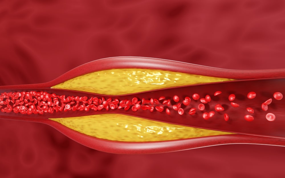 A combination of drugs against cholesterol would avoid tens of thousands of deaths