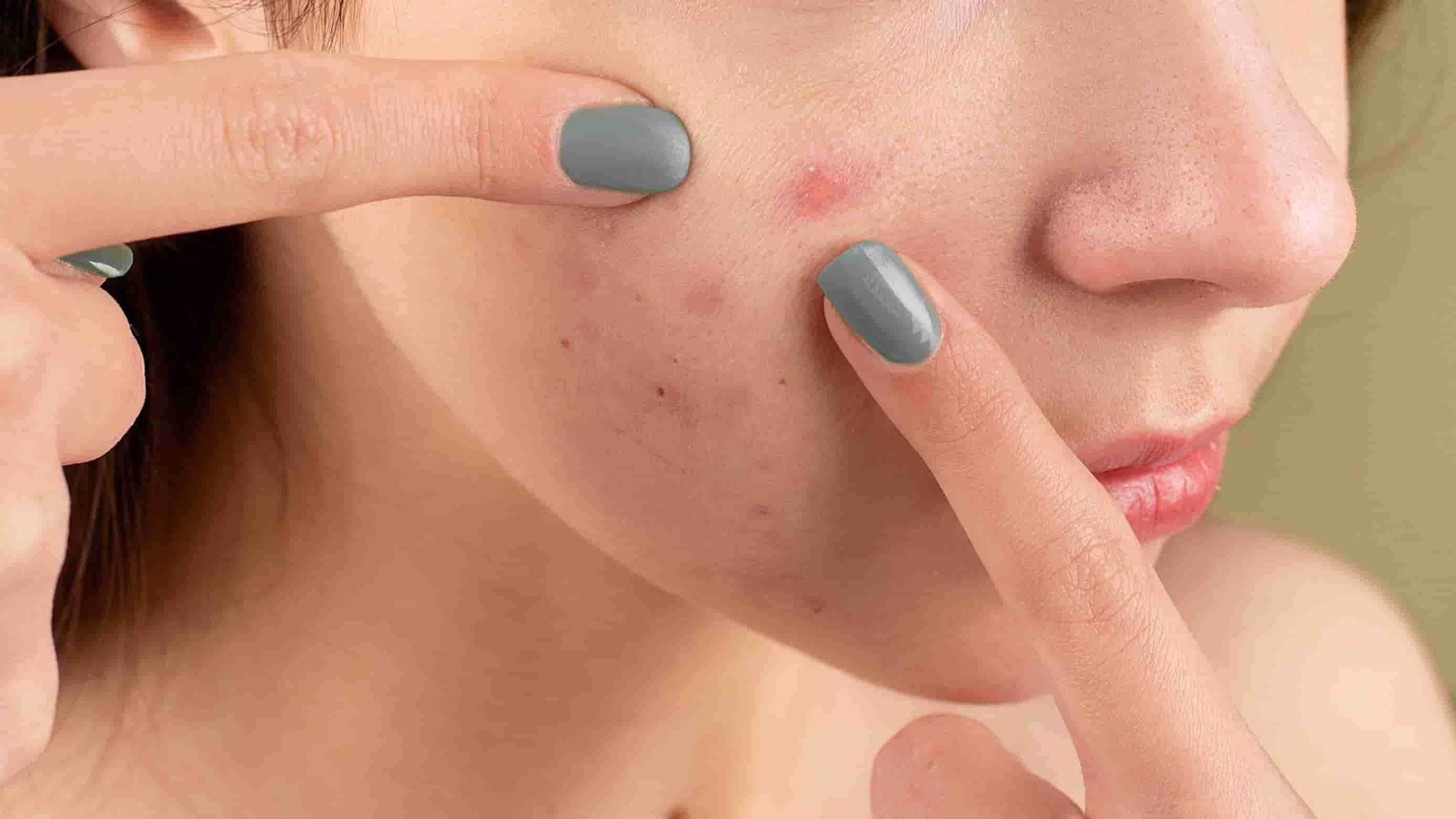 consequences and risks of the dermatillomania