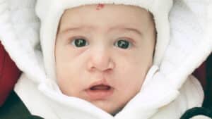 Hare lip: what it is, causes, diagnosis and treatment