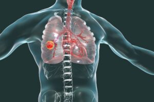 Lung cancer: a rare genetic mutation increases the risk in those who have never smoked